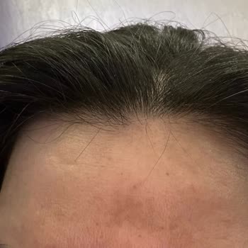 Garnier C Vitamini Serumları Alnımda Kocaman Leke Oluşturdu...