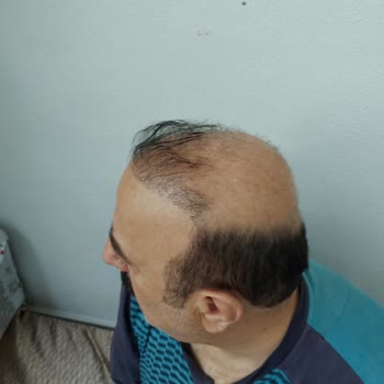 Emphair Saç Ekim Merkezi Emphair Mağduruyum! Dava Açacağım.