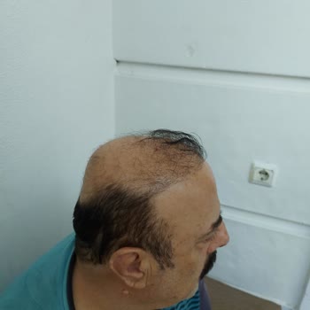 Emphair Saç Ekim Merkezi Emphair Mağduruyum! Dava Açacağım.