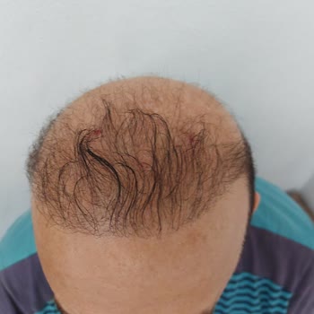 Emphair Saç Ekim Merkezi Emphair Mağduruyum! Dava Açacağım.