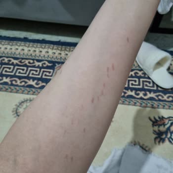 Epilady Kişisel Bakım Salonu Lazer Yanığı Ve İlgisizlikleri