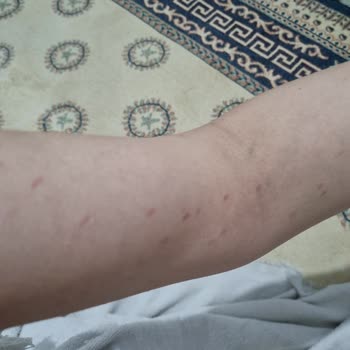 Epilady Kişisel Bakım Salonu Lazer Yanığı Ve İlgisizlikleri