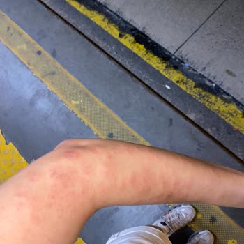 İstanbul Aydın Üniversitesi VM Medical Park Hastanesi Lazer Epilasyon Yanıkları