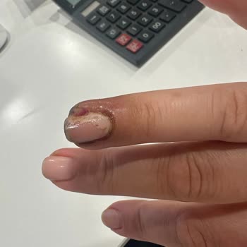 Gratis Beauty ArenaPark Tırnak Enfekte (mikrop) Olması