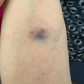 Eskişehir Osmangazi Üniversitesi Hastanesi Kan Alma Yapılırken