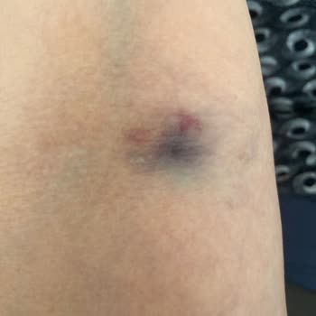 Eskişehir Osmangazi Üniversitesi Hastanesi Kan Alma Yapılırken