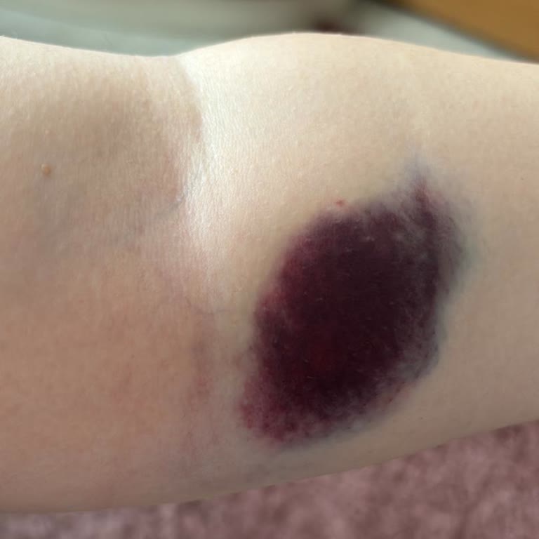 Nev Anadolu Hastanesi Kolumu Deştikten Sonra Yapamayacağım Diyen Hemşire?