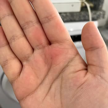 Altınkılıç Kefir Şişesi Patladı