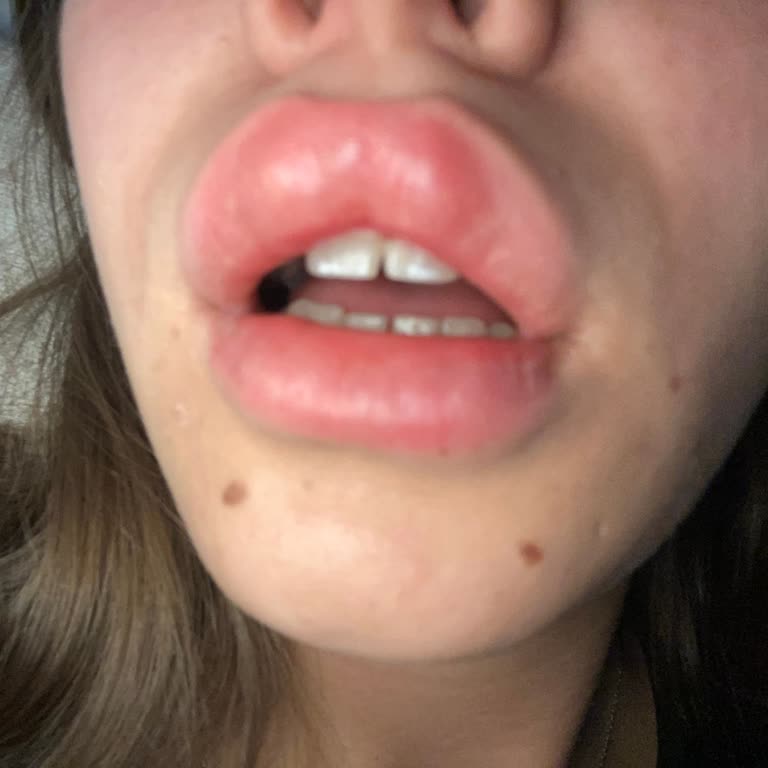 Green Life Güzellik Merkezi Dudak Dolgusu Dudağım Yamuldu