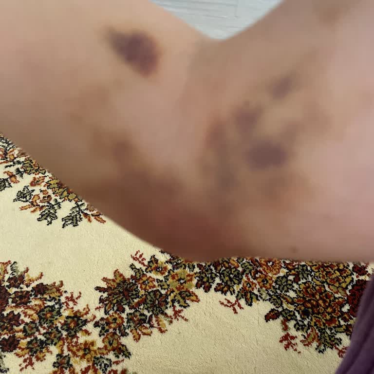 Metin Sabancı Baltalimanı Kemik Hastalıkları Eğitim ve Araştırma Hastanesi Kan Tahlili Sonrası Kolumda İç Kanama Ve Şiddetli Ağrı