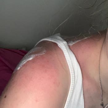 Dermokil Güneş Kremi Şikayet