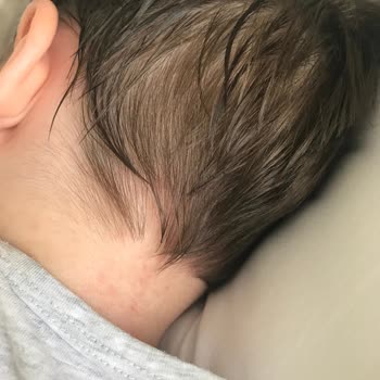 Mustela Güneş Kremi Alerji Sorunu