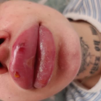 Büşra Aydemir Estetik Yabancı Madde İle Dudak Dolgusu