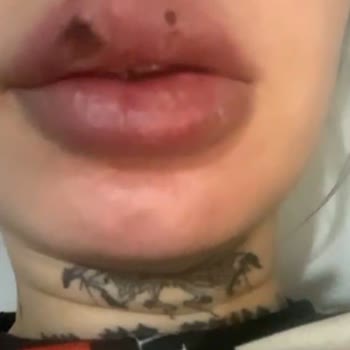 Büşra Aydemir Estetik Yabancı Madde İle Dudak Dolgusu