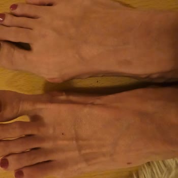 Ceyo Terlik Yaraları Ve Topuk Ağrısı