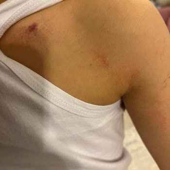 Gülveren Anaokulu Çocuğa Darp/Şiddet Uygulandı