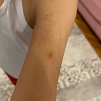 Gülveren Anaokulu Çocuğa Darp/Şiddet Uygulandı