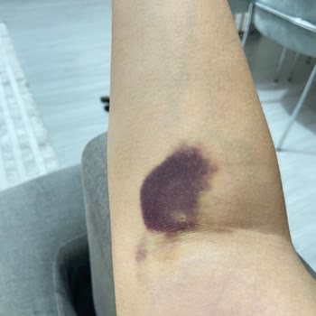 Türk Kızılay Kan Alımı Sonrası Yayılan Morarma Ve Ağrı