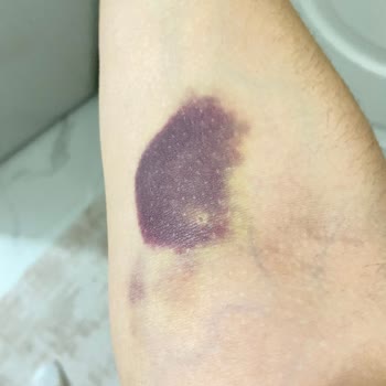Türk Kızılay Kan Alımı Sonrası Yayılan Morarma Ve Ağrı