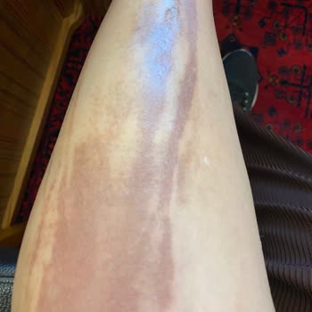Ulusoy Beauty (Sümeyye Çalışkan) Kimyasal Peeling ( Meyve Asitleri) Kullanımı Yanık Bacaklar!