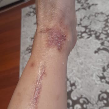 Ulusoy Beauty (Sümeyye Çalışkan) Kimyasal Peeling ( Meyve Asitleri) Kullanımı Yanık Bacaklar!
