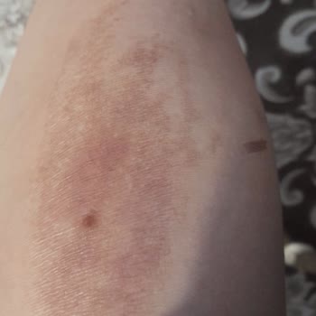 Ulusoy Beauty (Sümeyye Çalışkan) Kimyasal Peeling ( Meyve Asitleri) Kullanımı Yanık Bacaklar!
