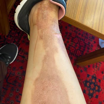 Ulusoy Beauty (Sümeyye Çalışkan) Kimyasal Peeling ( Meyve Asitleri) Kullanımı Yanık Bacaklar!