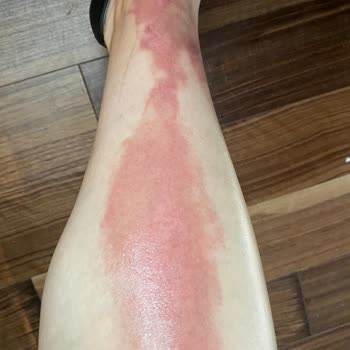 Ulusoy Beauty (Sümeyye Çalışkan) Kimyasal Peeling ( Meyve Asitleri) Kullanımı Yanık Bacaklar!