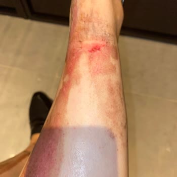 Ulusoy Beauty (Sümeyye Çalışkan) Kimyasal Peeling ( Meyve Asitleri) Kullanımı Yanık Bacaklar!