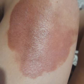 Ulusoy Beauty (Sümeyye Çalışkan) Kimyasal Peeling ( Meyve Asitleri) Kullanımı Yanık Bacaklar!