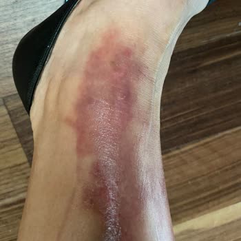 Ulusoy Beauty (Sümeyye Çalışkan) Kimyasal Peeling ( Meyve Asitleri) Kullanımı Yanık Bacaklar!