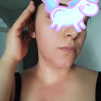 Eyüp Sabri Tuncer Gül Suyu Kızarıklık, Yanma Ve Alerji Yaptı