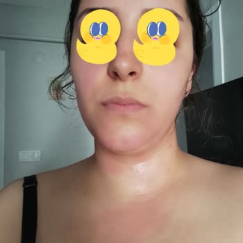 Eyüp Sabri Tuncer Gül Suyu Kızarıklık, Yanma Ve Alerji Yaptı