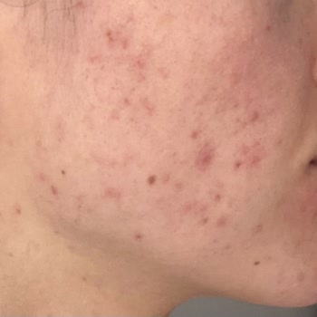 The Purest Solutions The Purest Markanın Ürünleri Cildimi Mahvetti