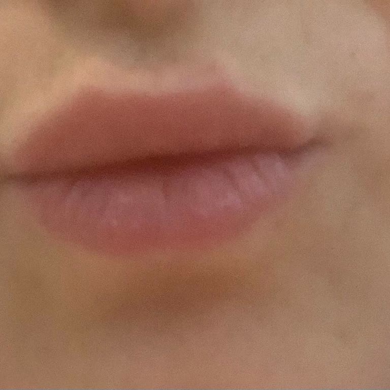 Uzm. Dr. Miray Tümer Yamuk Dudak Yapıldı