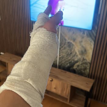 Taksim Eğitim ve Araştırma Hastanesi Alçıya Aldıkları Koluma Bakmıyorlar