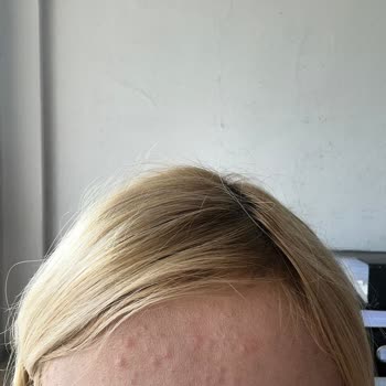 Note Cosmetics Note 3 İn 1 Sivilce Yaptı!