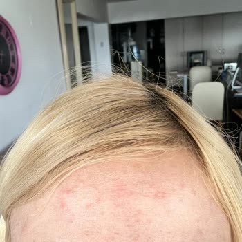 Note Cosmetics Note 3 İn 1 Sivilce Yaptı!