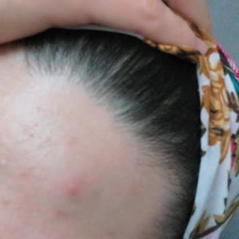 The Purest Solutions Daha Çok Sivilce Çıkmaya Başladı