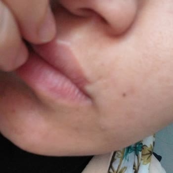 The Purest Solutions Daha Çok Sivilce Çıkmaya Başladı