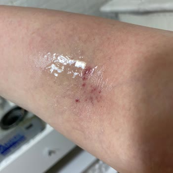 Bahar Kavi Kuaför Kol Yaralanması