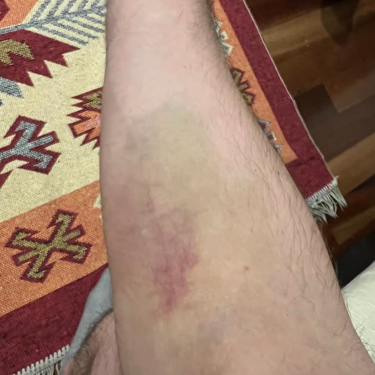 Türk Kızılay Kan Verme Sonucu Kolumda Oluşan Morluklar