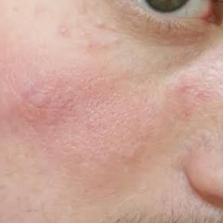 Ziaja Kremi Kullanımı Sonrası Cilt Sorunları