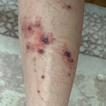 Climed Tedavi Merkezi Climed Clinik İzmir Şubede Varis Tedavisinde Yanlış İşlem Yapıldı