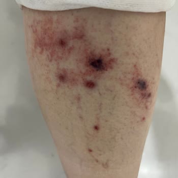 Climed Tedavi Merkezi Climed Clinik İzmir Şubede Varis Tedavisinde Yanlış İşlem Yapıldı