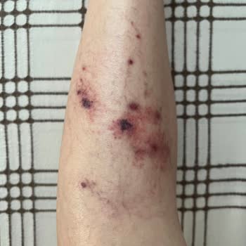 Climed Tedavi Merkezi Climed Clinik İzmir Şubede Varis Tedavisinde Yanlış İşlem Yapıldı