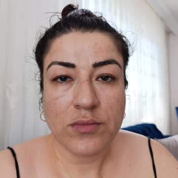 Awera Güzellik ve Estetik Yüzümde Yanık İzleri Kaldı İade Yapmıyorlar Engelliyorlar