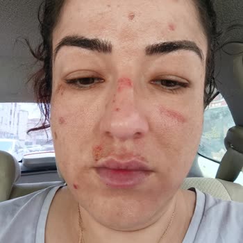 Awera Güzellik ve Estetik Yüzümde Yanık İzleri Kaldı İade Yapmıyorlar Engelliyorlar