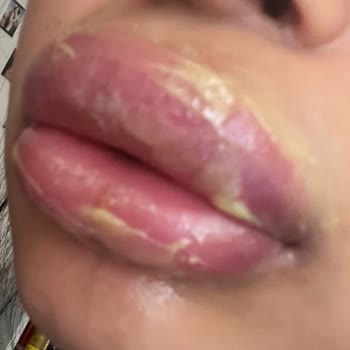 Ars Beauty & Center Hijyen Ve Uyuşturma Eksikliğiyle Kötü Dudak Dolgusu Deneyimi!