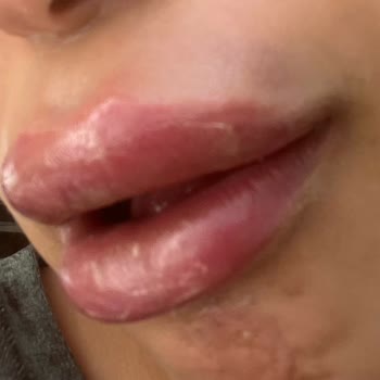 Ars Beauty & Center Hijyen Ve Uyuşturma Eksikliğiyle Kötü Dudak Dolgusu Deneyimi!